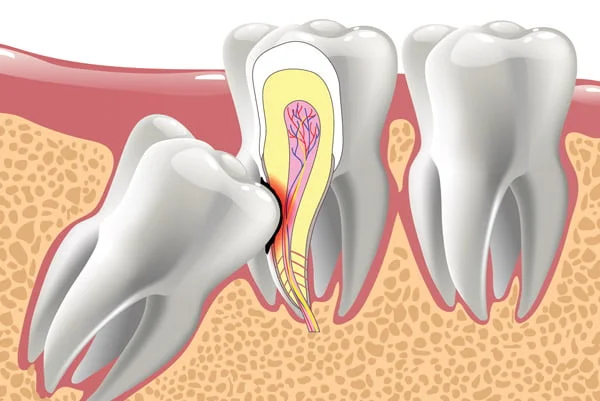extraction dents de sagesse Plateau-Mont-Royal