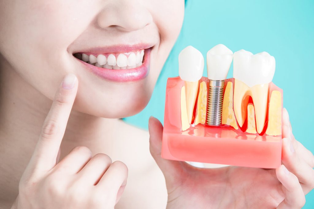 prothèse sur implant Montréal